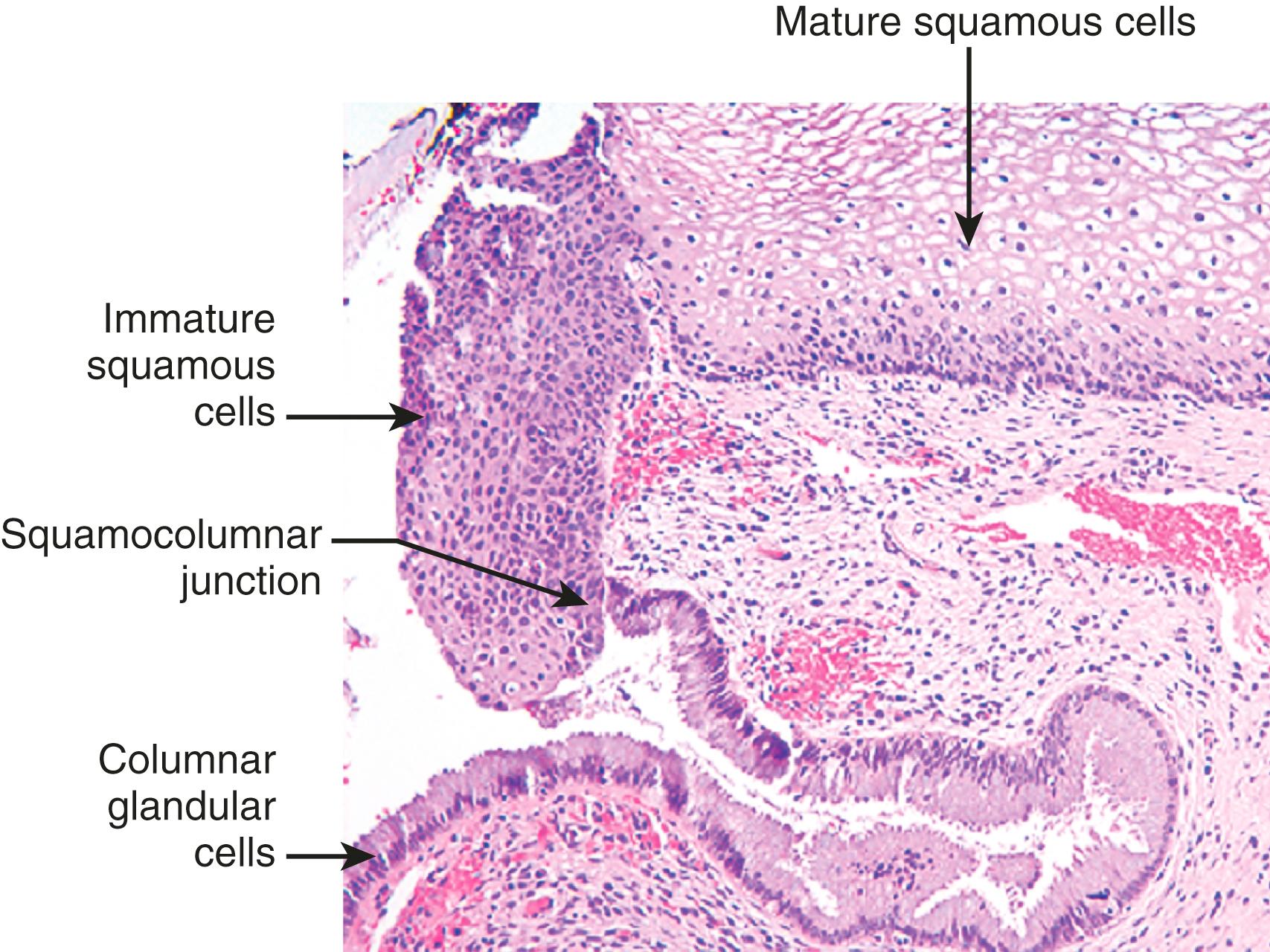 FIG. 17.4, Cervical transformation zone showing the transition from mature glycogenated squamous epithelium, to immature metaplastic squamous cells, to columnar endocervical glandular epithelium.