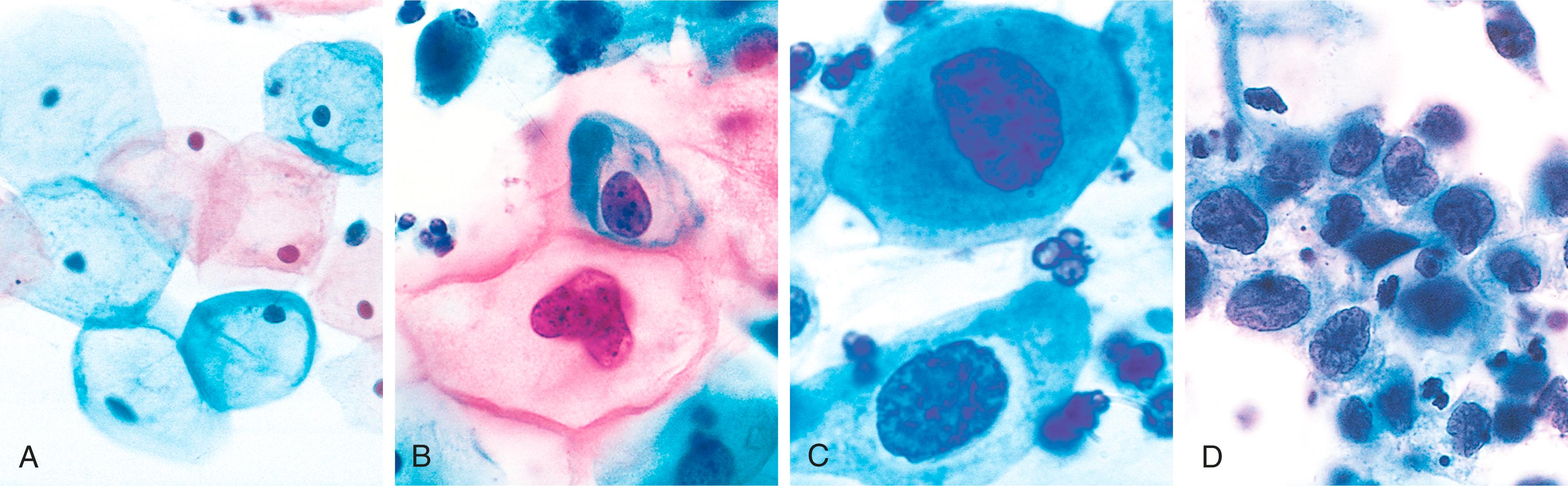 FIG. 17.7, Cytologic features of squamous intraepithelial lesion (SIL) in a Papanicolaou test. Superficial squamous cells may stain either red or blue. (A) Healthy exfoliated superficial squamous epithelial cells. (B) Low-grade squamous intraepithelial lesion (LSIL). (C and D) High-grade squamous intraepithelial lesions (HSILs). Note the reduction in cytoplasm and the increase in the nucleus-to-cytoplasm ratio as the grade of the lesion increases. This observation reflects the progressive loss of cellular differentiation on the surface of the cervical lesions from which these cells are exfoliated (see Fig. 17.6 ).