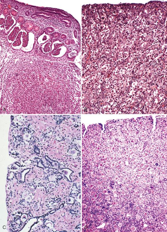 Fig. 1.5, Human ovarian development. A, Indifferent gonad at 6 weeks with primitive germ cells (lower). The metanephros is above. B, Germ cells at 19 weeks. Primordial follicles are not yet conspicuous. C, In midgestation, surface coelomic epithelium invaginates to invest oogonia, resulting in primordial follicles. D, At term, the cortex is filled with primordial follicles.