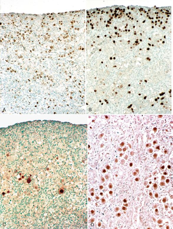 Fig. 1.6, Expression of OCT3/4, Ki-67, and TAp63 at 19 weeks' gestation. A, Ki-67 is expressed in immature germ cells and stromal cells, predominantly in the cortex. B, Expression of OCT4 predominates in the immature cortical germ cells. C, Expression of full-length p63 (TAp63) is limited to the maturing oocytes in the primordial follicles. D, At birth, TAp63 identifies a high percentage of oocytes in the ovarian cortex. Ki-67 and OCT3/4 are not expressed at this stage.