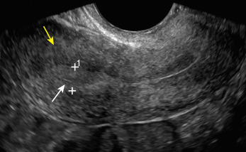 Fig. 23.2, Transvaginal longitudinal image of the uterus shows normal myometrium ( yellow arrow ) and endometrium ( white arrow ). Calipers measure endometrial thickness.