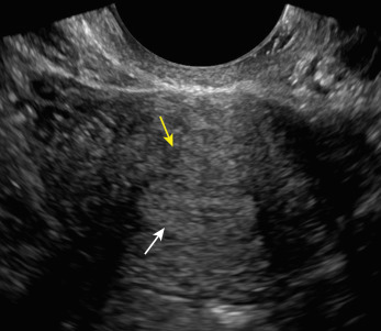 Fig. 23.3, Transvaginal transverse image of the uterus shows normal myometrium ( yellow arrow ) and endometrium ( white arrow ).