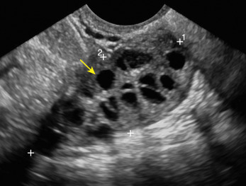 Fig. 23.4, Normal premenopausal ovary with multiple follicles ( yellow arrow ). Calipers and numerals measure ovarian size.