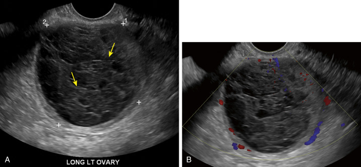 Fig. 23.5, (A) Hemorrhagic cyst with reticular lacelike pattern ( yellow arrows ). (B) No internal vascularity or solid component.