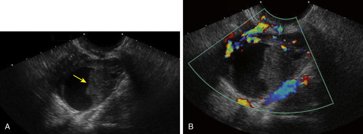 Fig. 23.6, (A) Retracting clot ( yellow arrow ) within a hemorrhagic cyst. (B) No blood flow within the clot.