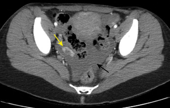 Fig. 23.7, Ruptured hemorrhagic cyst in the right ovary with enhancing irregular wall ( yellow arrow ) and hemoperitoneum ( black arrow ).