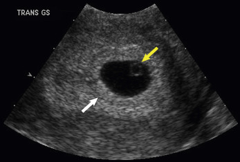 Fig. 24.1, Normal IUP. Gestational sac with double decidual sign ( white arrow ) containing a yolk sac ( yellow arrow ).