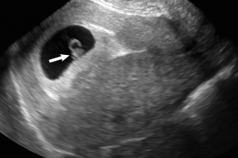 Fig. 24.2, Normal IUP. Gestational sac containing a yolk sac and an embryo ( arrow ).