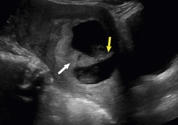 Fig. 24.3, Diamniotic dichorionic gestation. Thick intertwin membrane ( yellow arrow ) and twin peak sign ( white arrow ).