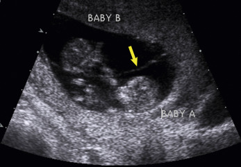 Fig. 24.4, Diamniotic monochorionic gestation. Thin intertwin membrane ( arrow ).