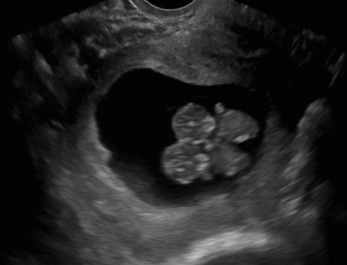 Fig. 24.5, Monoamniotic monochorionic gestation. No intertwin membrane.