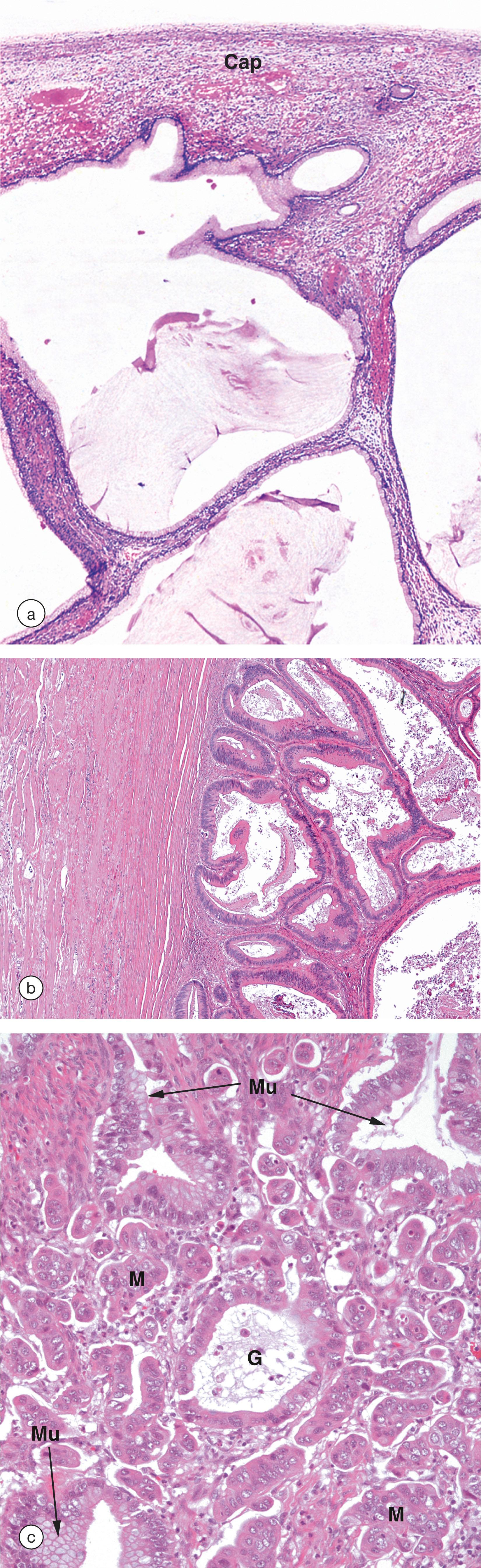 e-Fig 19.2, Mucinous ovarian tumours