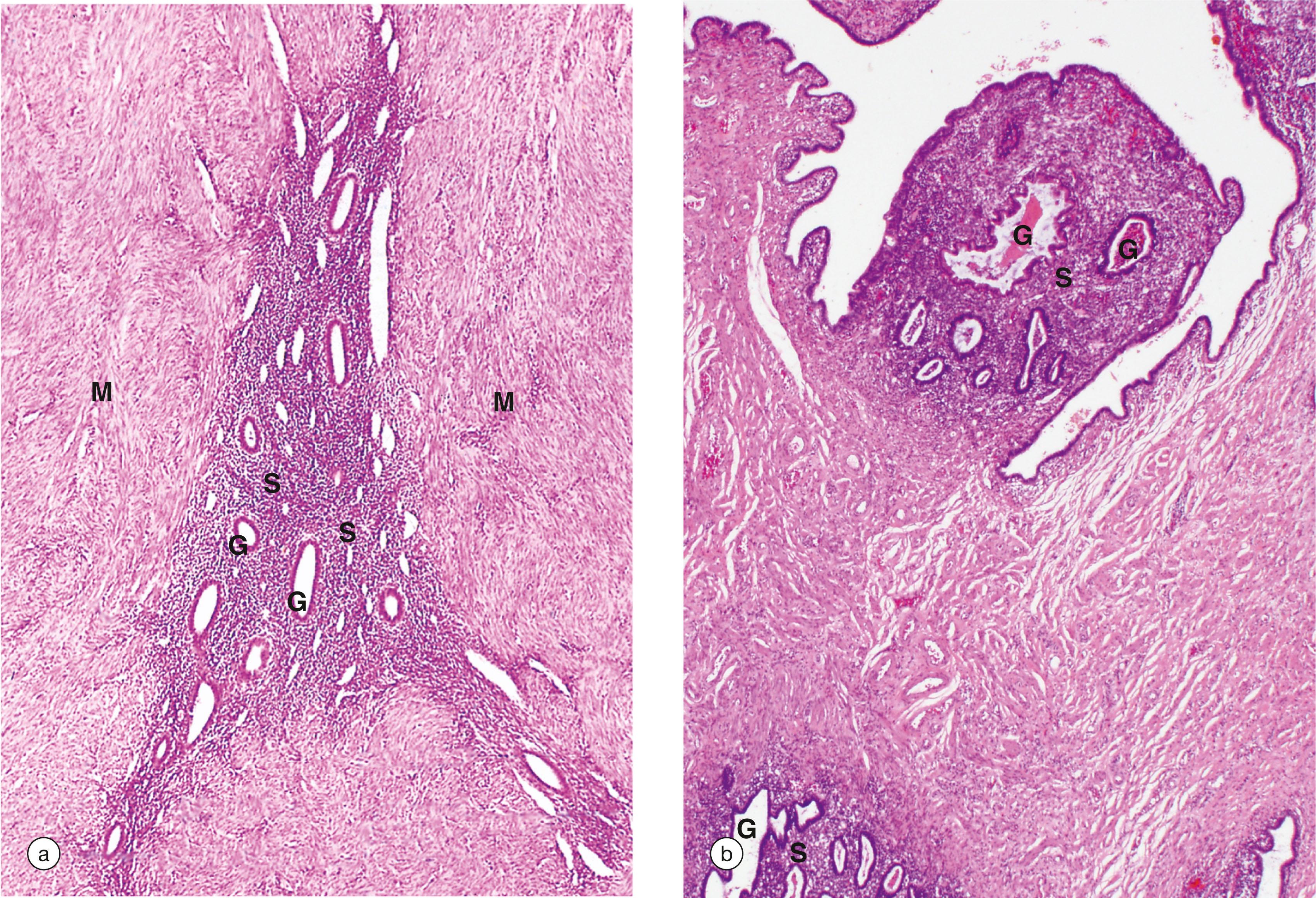 e-Fig. 19.5, Adenomyosis and endometriosis