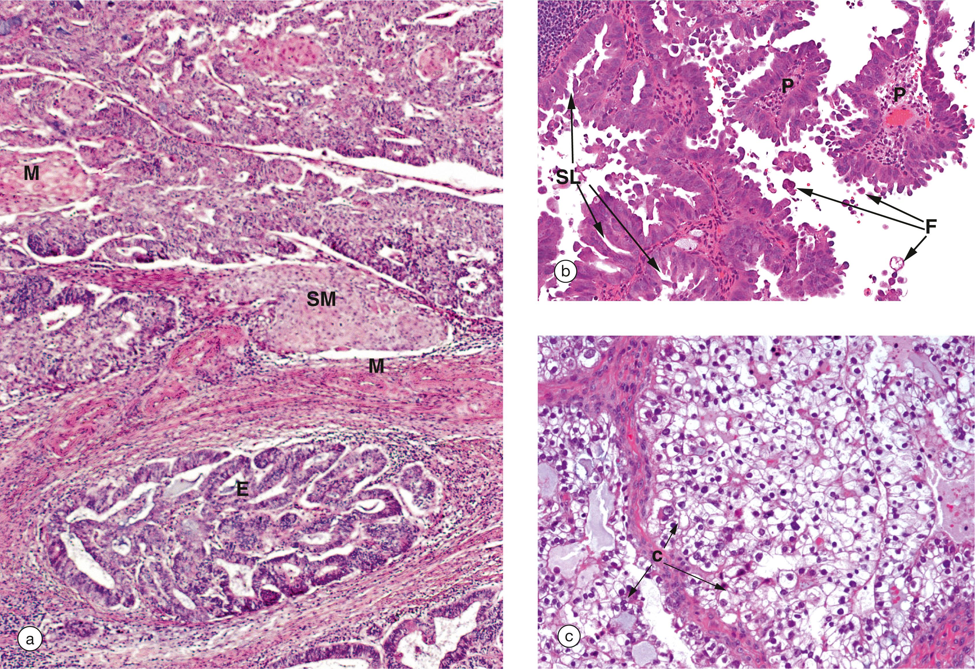 e-Fig. 19.6, Endometrial carcinoma