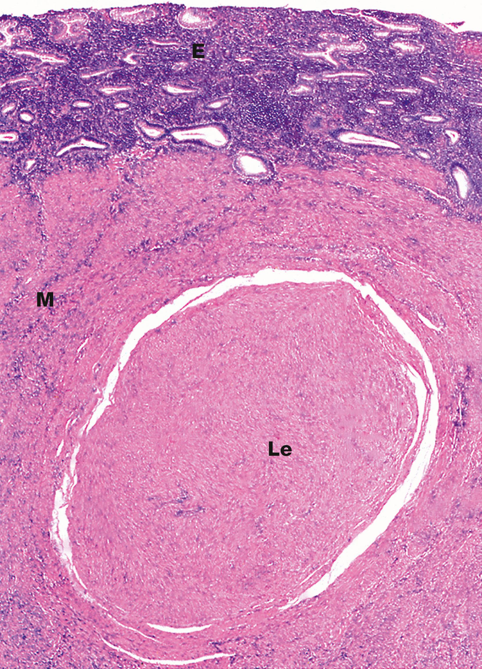 Fig. 19.22, Uterine leiomyoma H&E (LP)