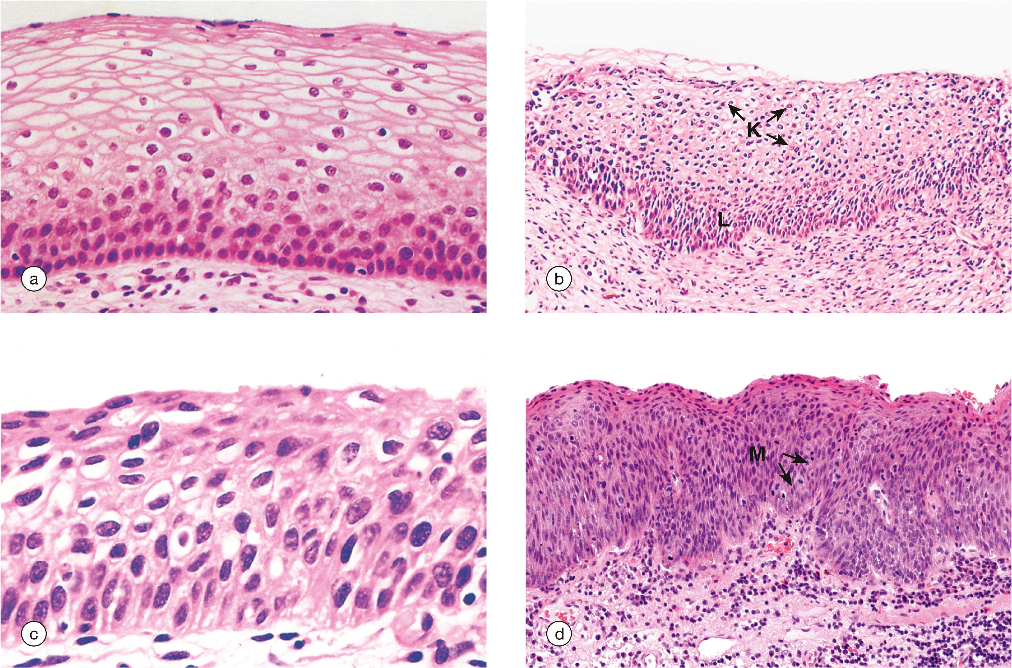 e-Fig. 19.7, Cervical intraepithelial neoplasia (CIN)