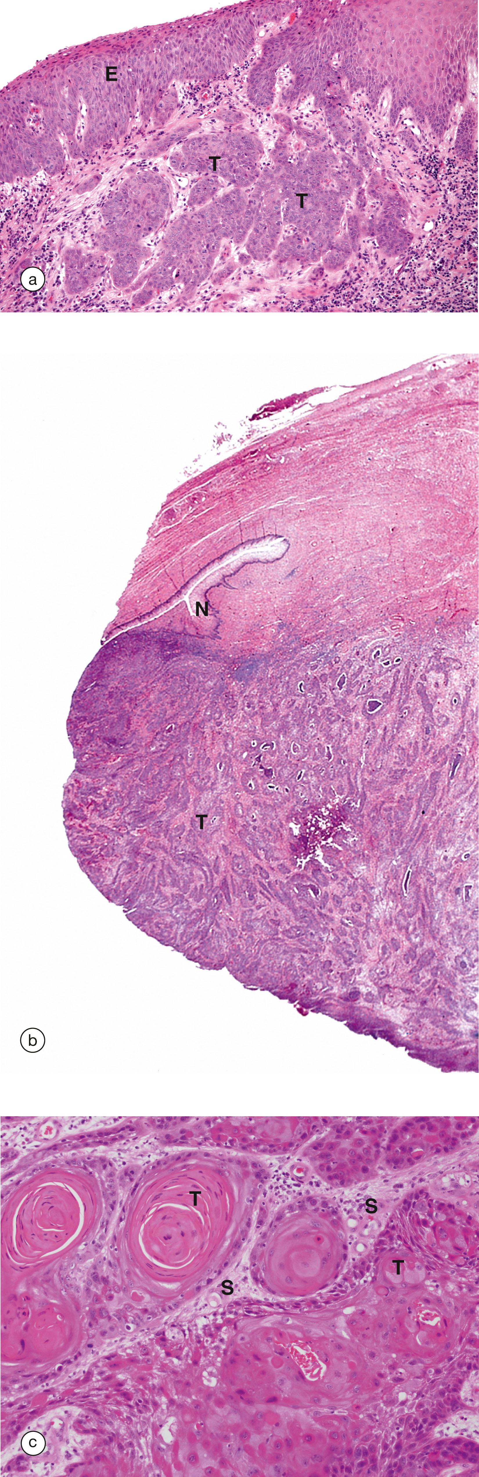 e-Fig. 19.8, Invasive squamous cell carcinoma of the cervix