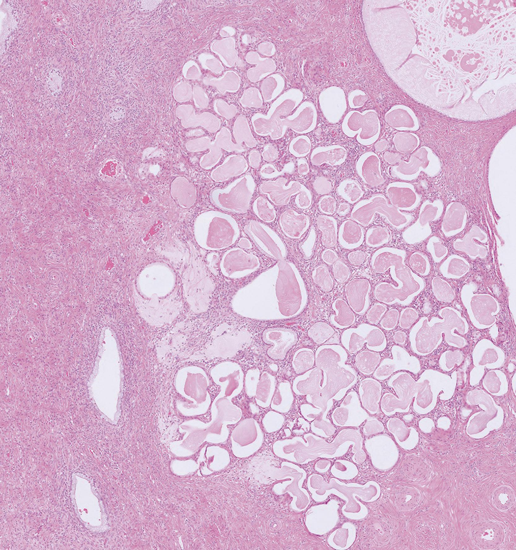 e-Fig. 19.9, Cervical tunnel clusters (LP)