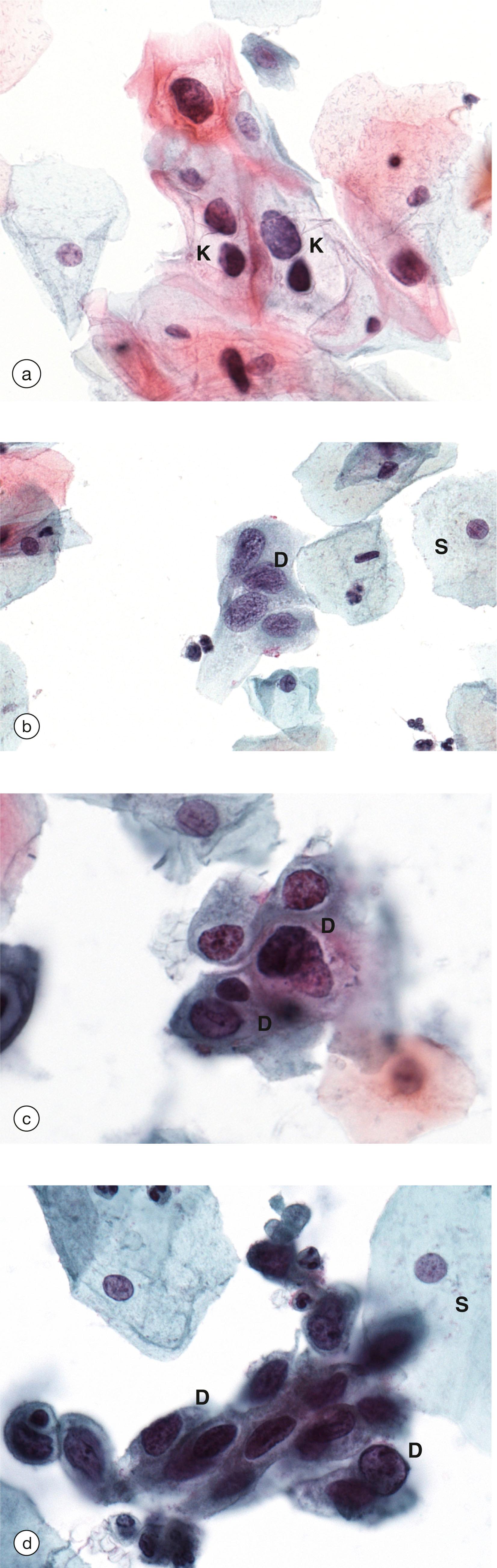 e-Fig. 19.10, Cervical cytology (HP)