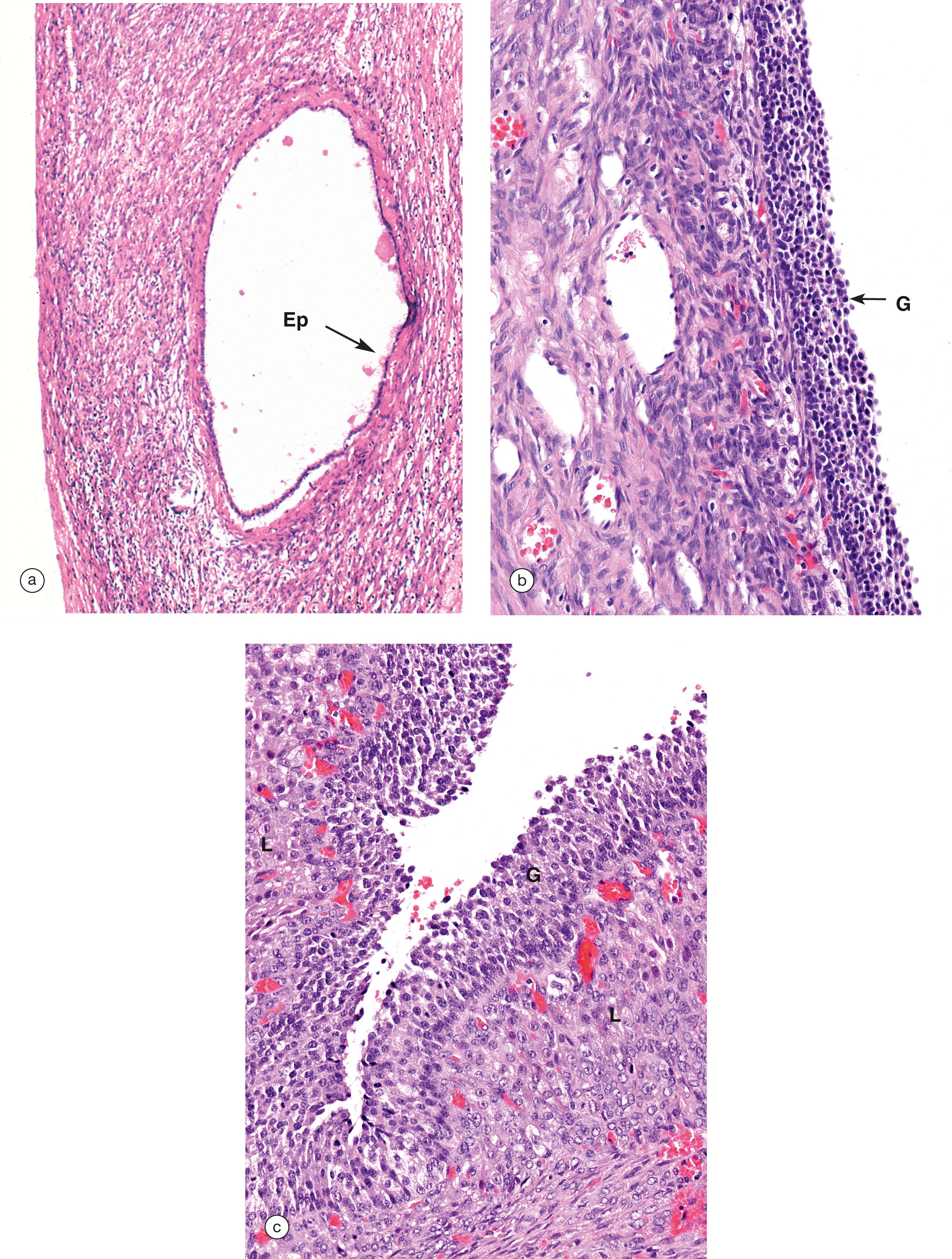 e-Fig. 19.1, Non-neoplastic ovarian cysts