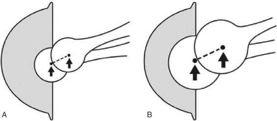 Fig. 73.2, Relationship between femoral head diameter and excursion distance. The distance that the femoral head must travel prior to complete dislocation is shorter with smaller-diameter femoral heads (A) compared to larger diameter femoral heads (B).