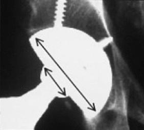 Fig. 73.3, The graduated femoral head size system proposed by Kelley et al. 25 is based on the diameter of the femoral head (shorter line) compared to the outer diameter of the acetabular component (longer line) as demonstrated on this anteroposterior radiograph of a right uncemented THA.