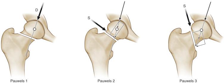 Fig. 43.1, The Pauwels classification.