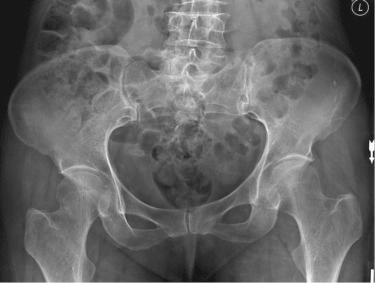 Fig. 43.2, Anteroposterior radiograph of a pelvis, demonstrating a displaced right femoral neck fracture.