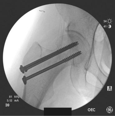 Fig. 43.3, Intraoperative C-arm image. Anteroposterior view shows internal fixation with three cancellous screws in an inverted triangle configuration.