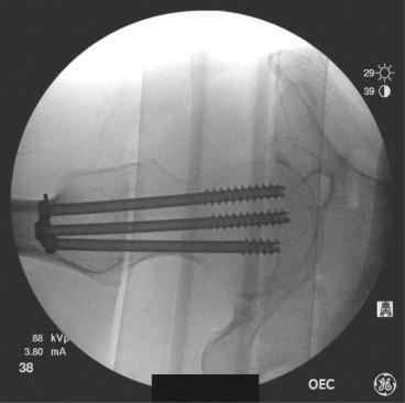 Fig. 43.4, Intraoperative C-arm image. A lateral view emphasizes the spread of the three cancellous screws for optimal fixation.