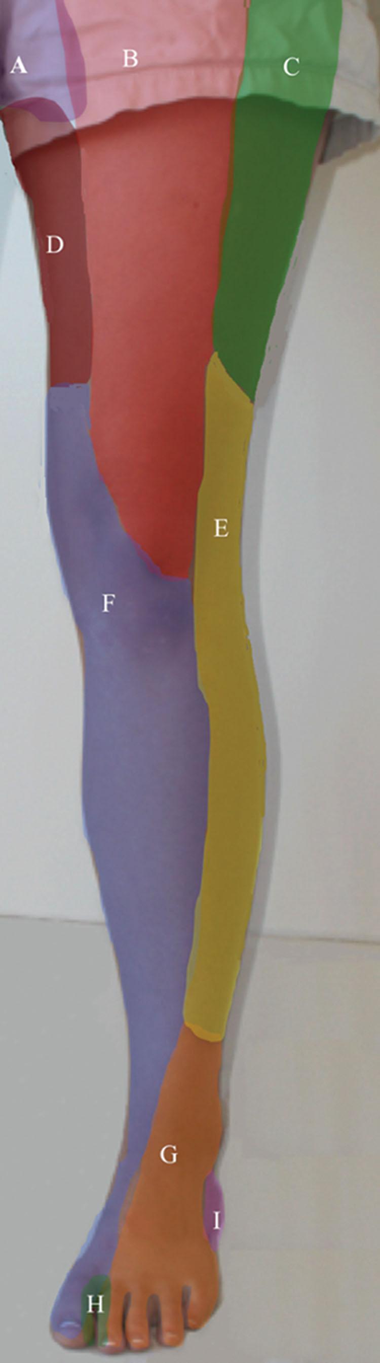 Figure 24.1, Pattern of pain from anterior lower extremity nerve entrapments. A = Genitofemoral nerve; B = femoral nerve; C = lateral femoral cutaneous nerve; D = obturator; E = lateral sural cutaneous nerve; F = saphenous nerve; G = superficial peroneal nerve; H = deep peroneal nerve; I = sural nerve.