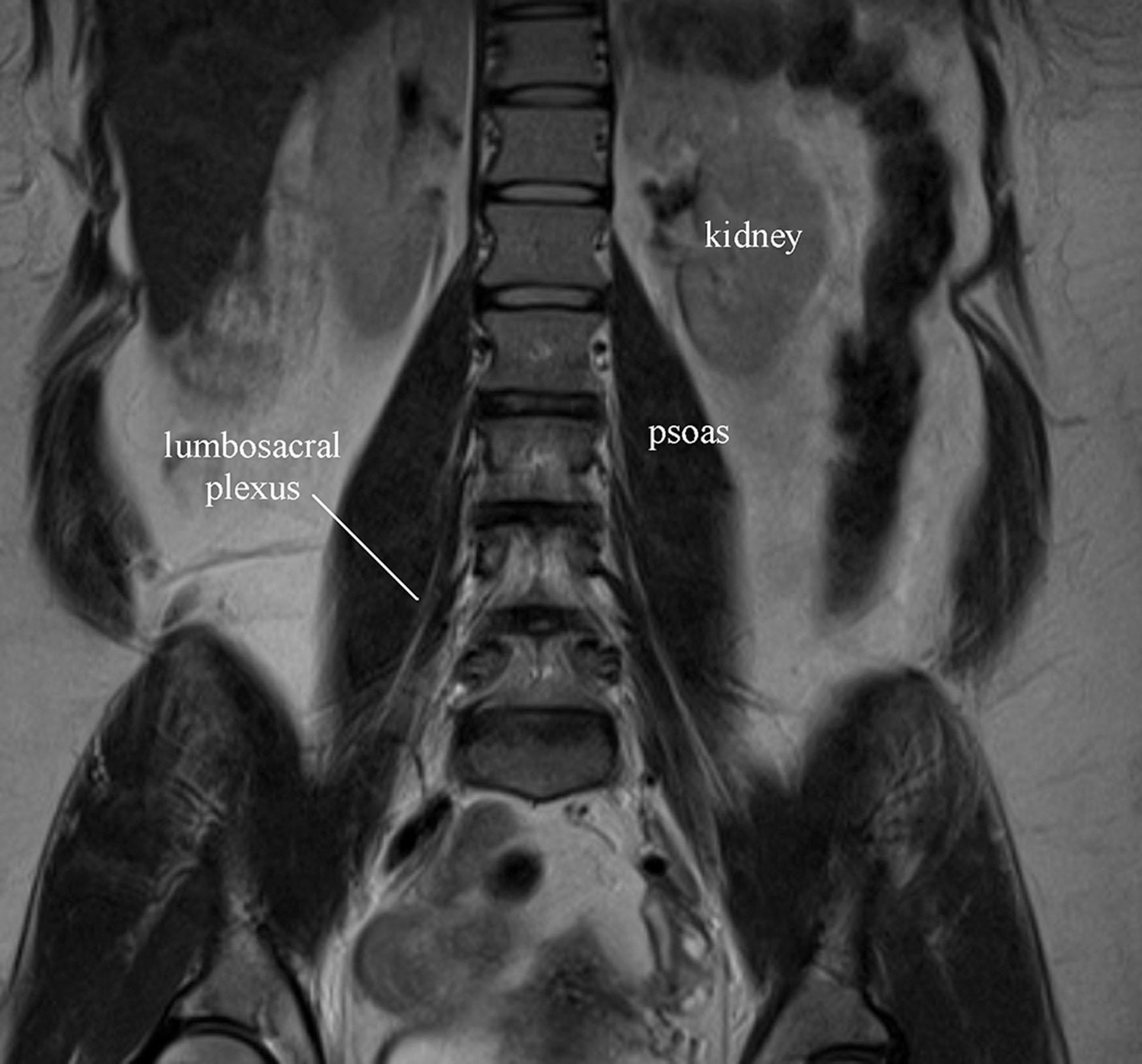 Figure 24.3, Lumbar plexus exiting the psoas muscle.