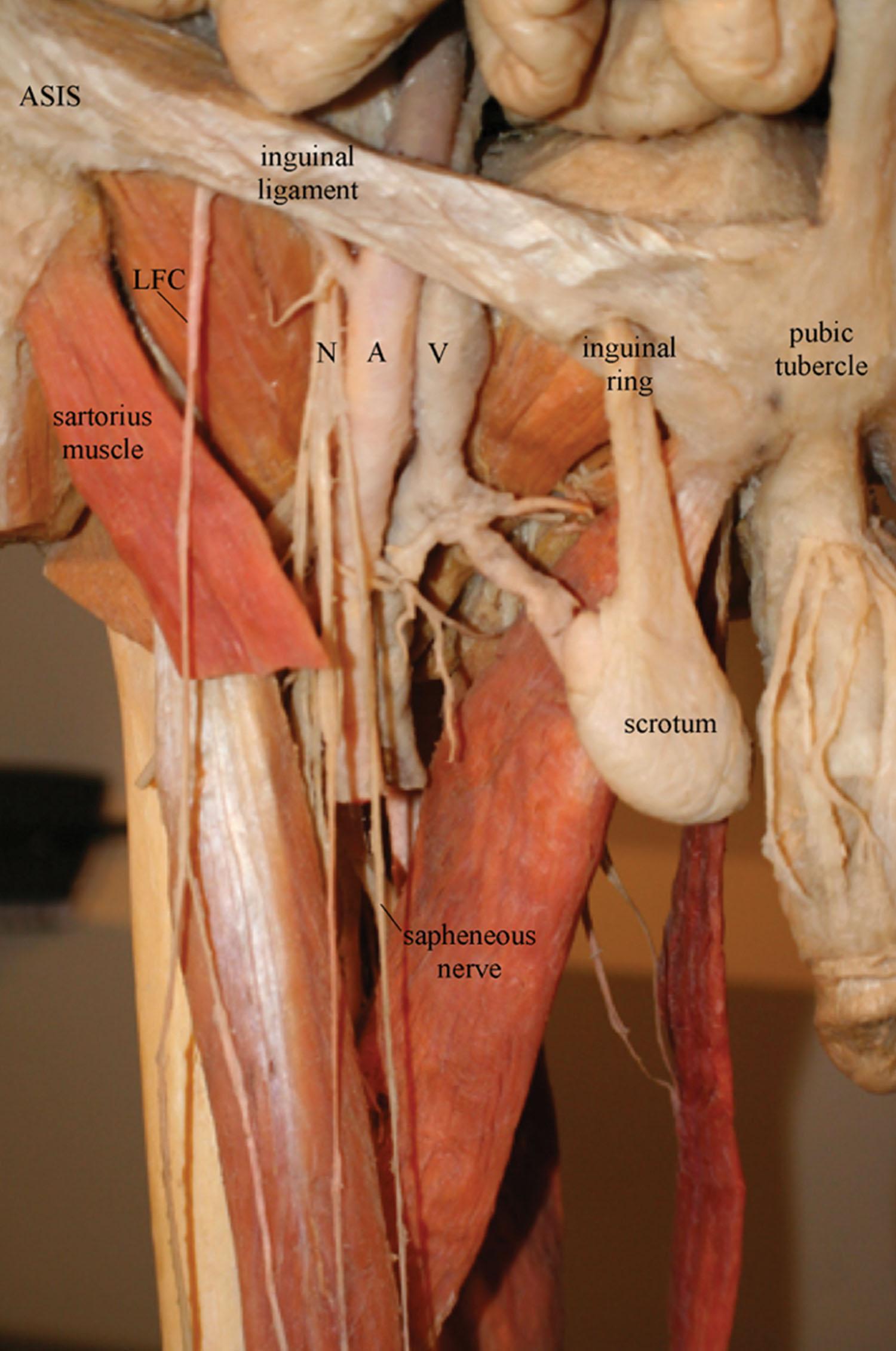 Figure 24.6, Dissection of the anterior thigh and groin. ASIS , anterior superior iliac spine; FA, Femoral artery; FN, Femoral nerve; FV, Femoral vein; LFC , lateral femoral cutaneous nerve.