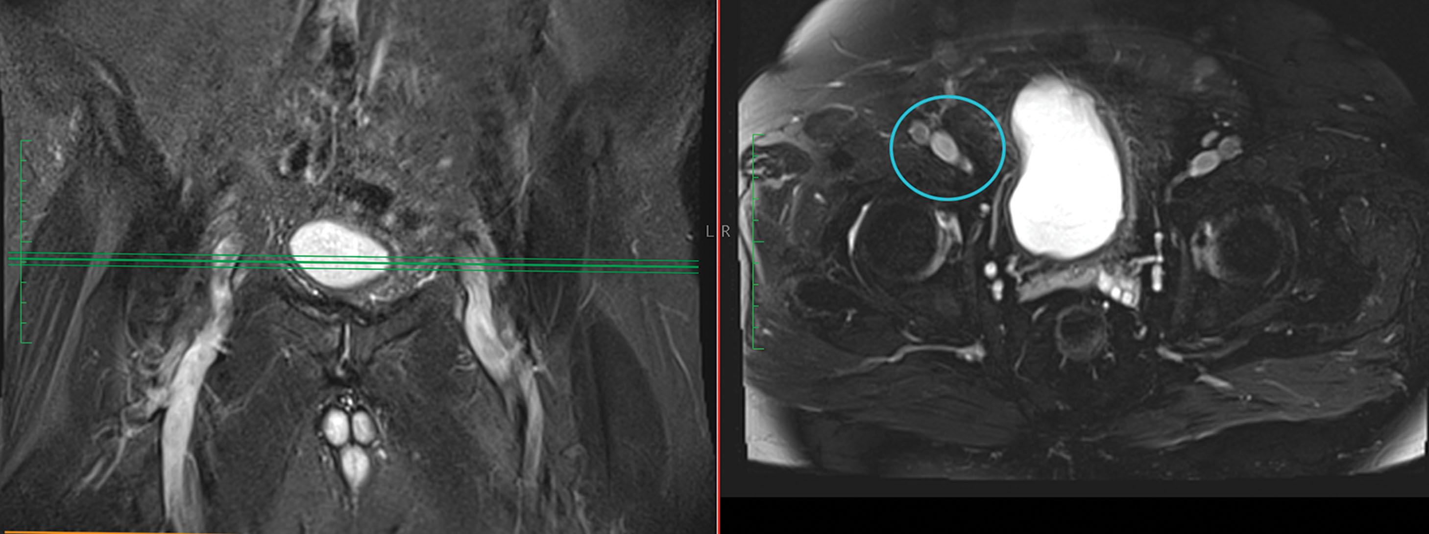 Figure 24.7, Magnetic resonance imaging showing the coronal and axial views of the femoral nerve. The “vein, artery, nerve” configuration is seen clearly in the circled portion of the image.