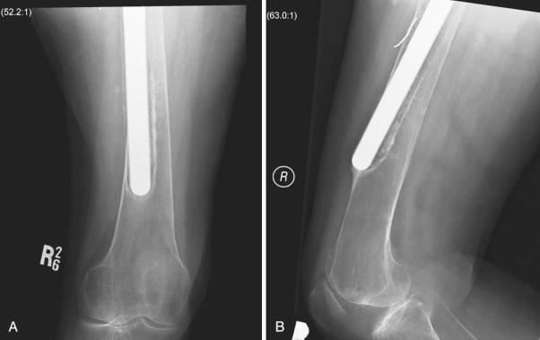 Fig. 103.1, Preoperative (A) anteroposterior (AP) and (B) lateral distal femoral radiographs showing uncontained severe femur bone loss.