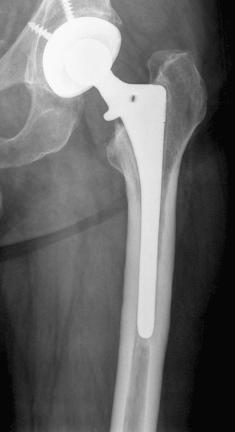 Fig. 97.1, Anteroposterior radiograph of a loose cementless femoral component illustrating a type I defect. There is minimal loss of the metaphyseal cancellous bone, with an intact femoral diaphysis.