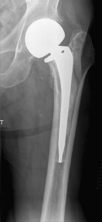 Fig. 97.2, Anteroposterior radiograph of a loose cemented femoral endoprosthesis illustrating a type II defect. There is extensive loss of the metaphyseal bone, with a completely intact femoral diaphysis .