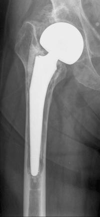 Fig. 97.3, Anteroposterior radiograph of a loose cemented femoral endoprosthesis illustrating a type IIIA defect. The femoral metaphysis is severely damaged and nonsupportive, but there is more than 4 cm of intact cortical bone in the femoral diaphysis distal to the failed implant.