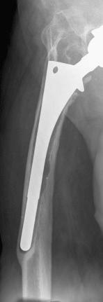 Fig. 97.4, An anteroposterior radiograph of a loose cementless femoral component that has migrated into varus. The severe varus femoral remodeling associated with this necessitates an extended trochanteric osteotomy at the time of revision surgery to ensure proper implant alignment and to allow access to the femoral canal without risking a perforation.