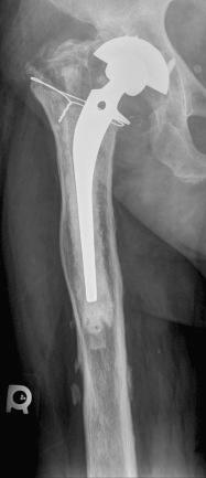 Fig. 97.5, An anteroposterior radiograph of a loose cemented femoral component illustrating a type IIIB defect. The metaphysis is severely damaged and nonsupportive. The intact diaphyseal cortical bone distal to the failed stem is less than 4 cm in length due to severe osteopenia.