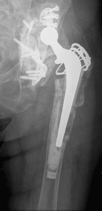 Fig. 97.6, An anteroposterior radiograph of a loose cemented femoral component illustrating a type IV defect. There is extensive metaphyseal and diaphyseal damage in conjunction with a widened femoral canal.