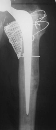 Fig. 99.1, Femoral impaction grafting with a medial mesh to contain the allograft in the calcar region.