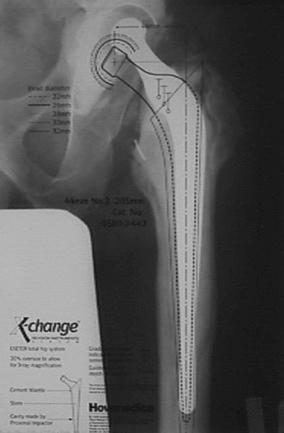 Fig. 99.2, Preoperative templating.