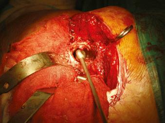 Fig. 99.3, Checking the femoral canal diameter with a canal sizer.