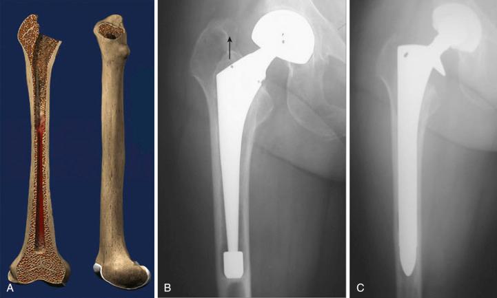 Fig. 100.1, Illustration (A) and preoperative (B) and postoperative (C) revision radiographs of a Paprosky type I defect treated with a fully porous-coated stem.