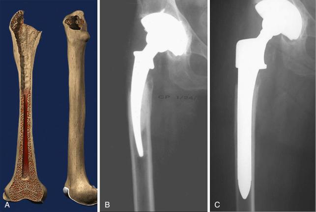 Fig. 100.2, Illustration (A) and preoperative (B) and postoperative (C) revision radiographs of a Paprosky type II defect treated with a fully porous-coated stem.