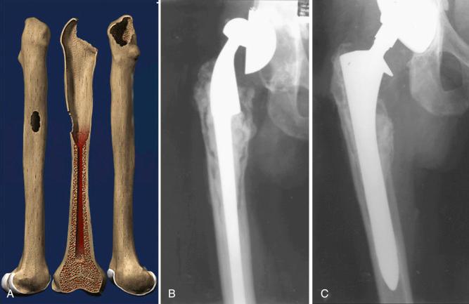 Fig. 100.3, Illustration (A) and preoperative (B) and postoperative (C) revision radiographs of a Paprosky type IIIA defect treated with a fully porous-coated stem.