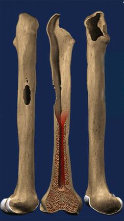 Fig. 100.4, Illustration of a Paprosky type IIIB defect.