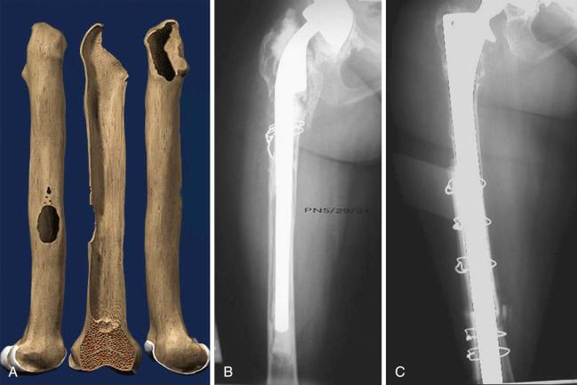 Fig. 100.5, Illustration (A) and preoperative (B) and postoperative (C) revision radiographs of a Paprosky type IV defect treated with a fully porous-coated stem.