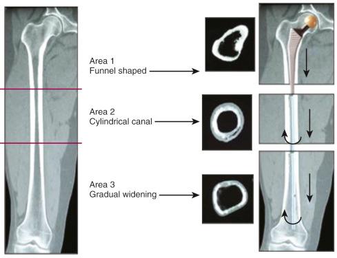 Fig. 101.2, The choice of a revision implant according to the stability provided by the remaining sound bone.